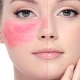 rosacea rvitis medellin