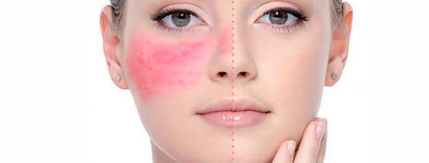 rosacea rvitis medellin